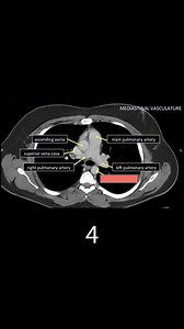 Learn CT anatomy (part 3) Reposted | CTisus: Cutting edge information on body CT (Computed tomography).