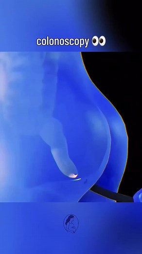 Colonoscopy: How Colon Cancer is Detected 👀
