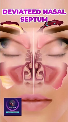 The Nasal Septum: Why It Matters for Your Breathing