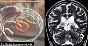 Doctors Dumbfounded At ‘Once-In-A-Career Finding’ After 3-Inch Worm Was Discovered In Patient’s Brain