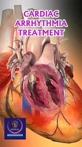 4.8K views · 41 reactions | Cardiac Arrhythmia Treatment - Catheter Ablation #CardiacArrhythmia #medicalstudent | Medical Animation Media | Facebook