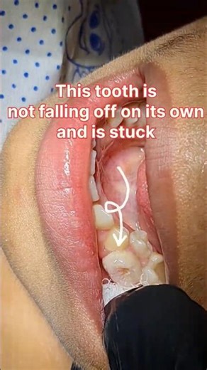 No Tears! Milk Tooth Removal ASMR 🦷 #asmr #dentist #satisfying