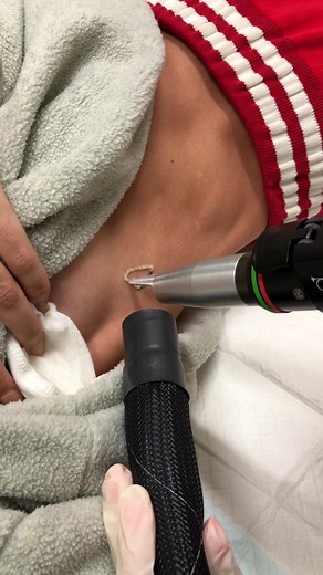 Effective Rib Tattoo Removal Process with Numbing Cream | Chapel Street