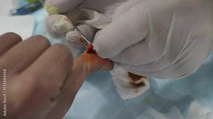 Surgery of the thumb of the hand with instruments closeup