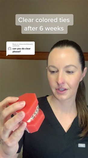 Clear Braces Colors: Transforming After 6 Weeks