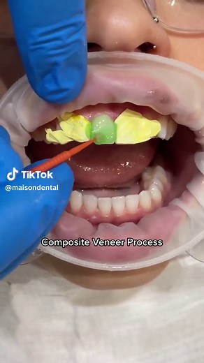 Dr Richard using direct composite veneers to correct the shape & position of the teeth. The composite veneers also allowed for the gaps to be closed. Composite veneers are a process where the composite resin is placed over the full front surface of the tooth. In this way we can change the colour of the tooth also ☁️🤍