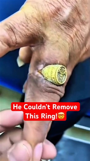 What Happens If You Never Remove a Ring