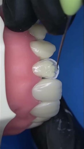 Dental Composite layering technique...!!!#dentist #dentaleducation #dentaltips