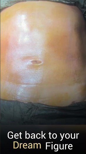 Abdominal Liposuction Before and After | Rejuvena Cosmo Care in Jaipur | Dr. Deepesh Goyal