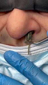 605K views · 2K reactions | Rare species removed from nose. A doctor...