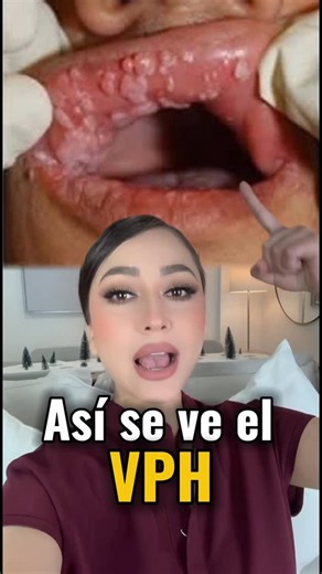 Paulina Zúñiga on Instagram: "El Virus del Papiloma Humano (VPH) es una de las infecciones virales más comunes del mundo. Existen más de 200 tipos, y cada uno se comporta de manera distinta: algunos causan verrugas visibles y otros pueden provocar lesiones que, si no se detectan a tiempo, aumentan el riesgo de cáncer. 🧬 ¿Qué es exactamente el VPH? Es un virus que infecta la piel y las mucosas. En muchos casos el cuerpo lo elimina por sí solo, pero algunos tipos pueden persistir y causar probl