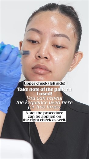 1.1K views | Today, we have Part 4 of our series on safely using your microneedling device at home.⁠ ⁠ This step focuses on the cheeks.⁠ An area where proper technique makes all the difference. ⁠ ⁠ Learn how to control your pressure, angles, and movement to achieve safe, effective results while treating this larger facial zone with confidence.⁠ ⁠ ⁠ #acnetreatment #skincare #antiaging #skintreatment #DrPen | Dr. Pen Global | Facebook