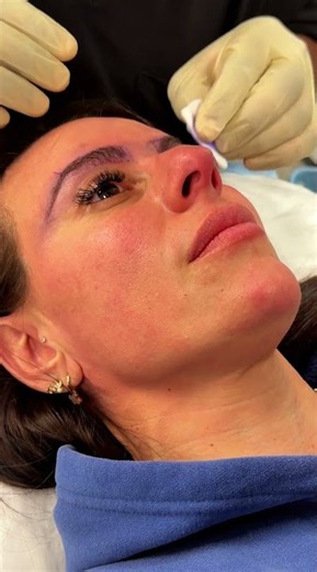 Eyebrow Transplant Procedure in Sydney | How Eyebrow Restoration Is Performed