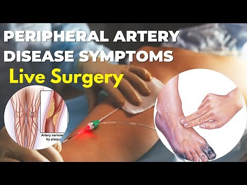 Peripheral Artery Disease In Legs | peripheral Balloon Angioplasty And Stenting