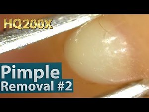 #2 Pimple(acne) Removal Close up 200X - Blackheads Removal | 200倍でニキビを潰す芯を除去