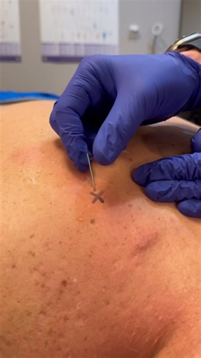 159K views · 424 reactions |  Dry Needling Dry needling is a modern...
