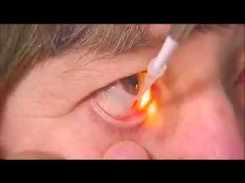 Tear Film Breakup Time