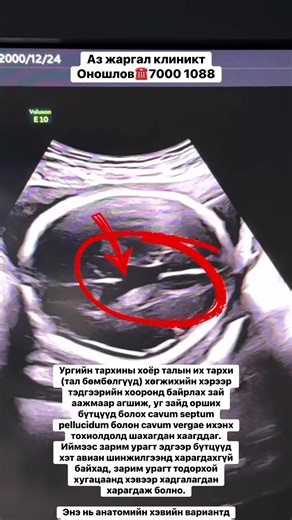 Ургийн тархины хоёр талын их тархи (тал бөмбөлгүүд) хөгжихийн хэрээр тэдгээрийн хооронд байрлах зай аажмаар агшиж, уг зайд орших бүтцүүд болох cavum septum pellucidum болон cavum vergae ихэнх тохиолдолд шахагдан хаагддаг. Иймээс зарим урагт эдгээр бүтцүүд хэт авиан шинжилгээнд харагдахгүй байхад, зарим урагт тодорхой хугацаанд хэвээр хадгалагдан харагдаж болно. Энэ нь анатомийн хэвийн вариантд тооцогдох боловч, заавал ургийн тархины бусад бүтцүүдийг нарийвчлан үнэлж, хавсарсан өөр гаж хөгжил, өө