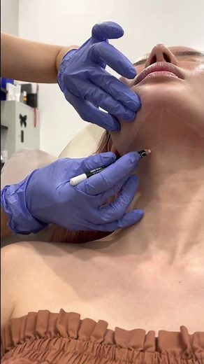 Mesolipo Treatment To Remove Double Chin