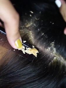 Dandruff sound heals quiet minds. | Flake Lab