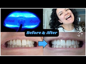 Laughland Teeth Whitening At Home Kit Review | Before & After Results
