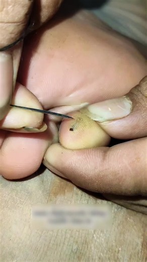 💎👀Removing 2 deeply embedded splinters step by step! Pure 5-minute relief 🔥👇#oddlysatifying #splinterRemova #education #usa🇺🇸 #Toecare