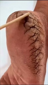 Repair Cracked Heels At Home Easily/Get Soft & Smooth Feet . . . #cracked #heels #crackedheels #softfeet #smoothfeet #feetcare #fypシ゚viralシfypシ゚viralシalシ #fbreelsfypシ゚viralvideo #fypviralシ #reelsfypシ #fbreelsfypシ゚ #explorepage | Natural Beauty Remedy