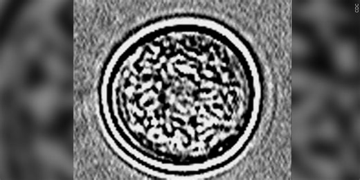 Patient dies from brain-eating amoeba, hospital says