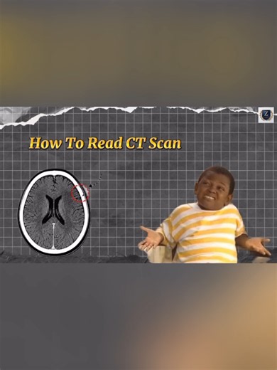 CT_Scan | how to read CT_Scan in simple words 🩺✅💯..... #medicalinformation #medicalkhnowledge #medicalstudent #vewsproblem🥺 #plzviral🥺🥺🙏🙏foryoupagel🥺🥺🙏🙏foryoupage .....