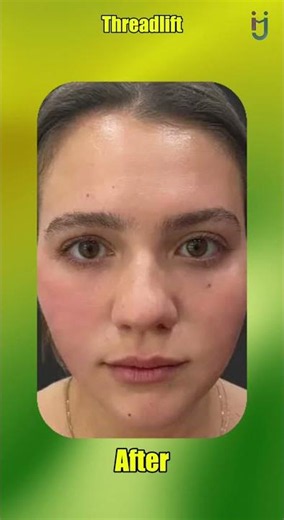 Thread lift Treatment Procedure
