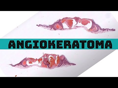 Angiokeratoma under the microscope (pathology dermpath dermatology dermatopathology)
