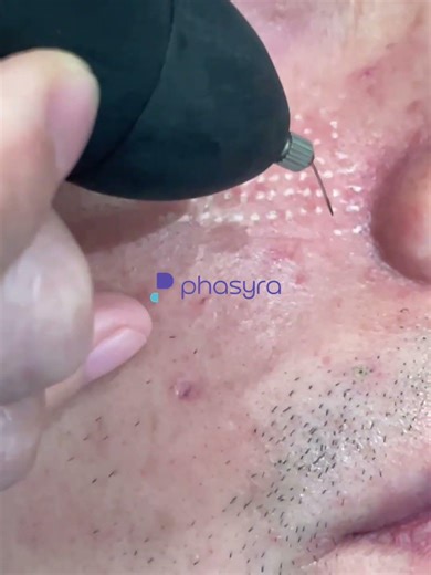 Glow Deeper Than Your Pores with Thermal Plasma Therapy!