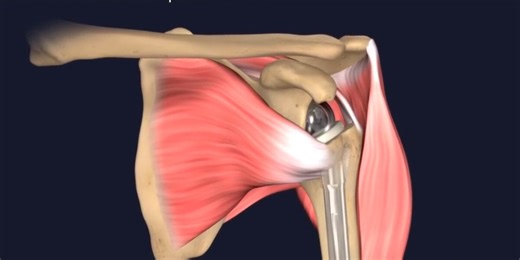 Reverse shoulder surgery: Rethinking implants