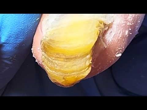 Poor Nails Infected By Fungus, Professional Pedicure Cleaning【Podiatry Clinic】