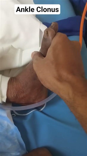 Ankle Clonus #clinical #neurology