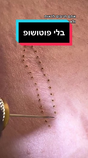 זה לא פוטושופ #פלזמה #פלזמהפיברובלסט #הרמתעפעפיים #מתיחתפנים #מתיחתבטן #סימנימתיחה #סירחיעור #הסרתנגעיעור