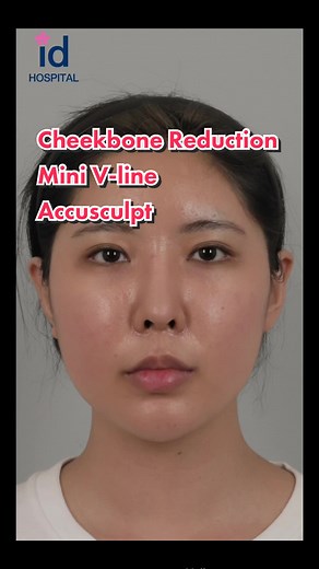 Cheekbone Reduction & V-Line Surgery at ID Hospital Korea