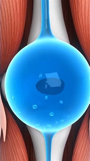 Baker's Cyst Fluid Dynamics