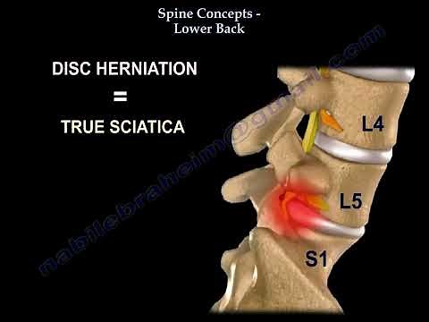 Low Back pain. Lumbar disc herniation, causes ,diagnosis ,symptoms and treatment