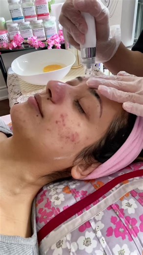 Hydrafacial Tutorial for Acne Prone Skin in Brampton