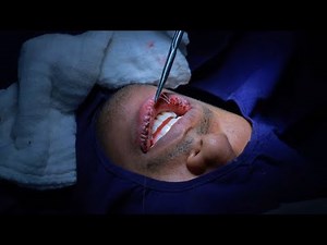 Lip Reduction Cosmetic Surgery | Before and After Results