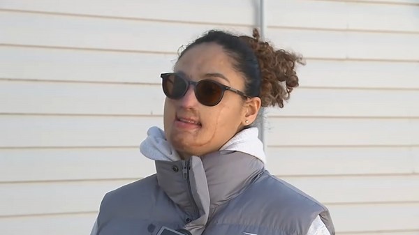 Acid attack case that scarred woman in Elmont, Long Island still unsolved after 4 years