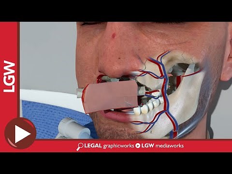 Maxilla Reconstruction Surgery Using a Fibula Flap 3D animation