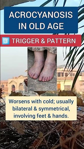 Acrocyanosis in Cold Weather