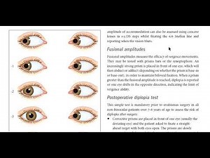 kanski clinical ophthalmology made easy - strabismus 6 (Hess chart)