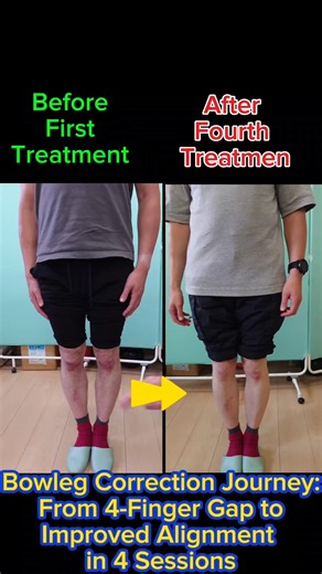 Bowleg Correction Journey: From 4-Finger Gap to Improved Alignment in 4 Sessions
