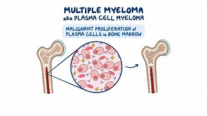 Video: Multiple myeloma: Nursing - Video Explanation! | Osmosis | Osmosis