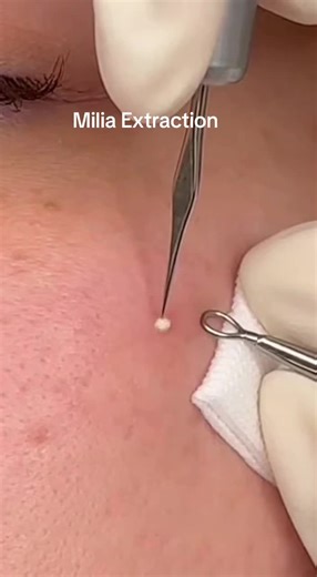 Milia Extraction Techniques You Need to Know