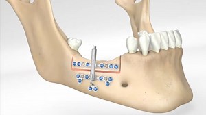 Distraction Osteogenesis 32 options from KLS Martin 牵引成骨术 | KLS Martin 提供 32 种方案