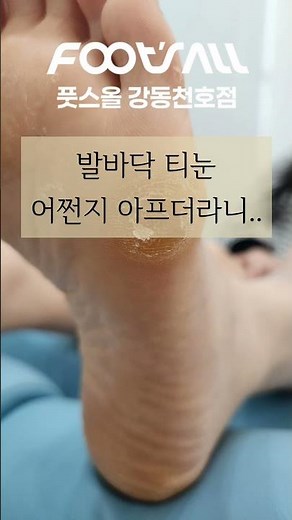 발바닥티눈제거방법ㅣ러닝굳은살ㅣ출산후생긴티눈굳은살ㅣ발가락사이티눈